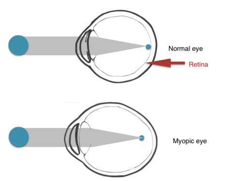myopic-eye-diagram